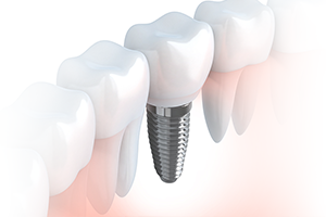 インプラントをご検討される方へ